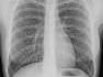 Thorax-Röntgenaufnahme der menschlichen Lunge