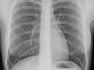 Thorax-Röntgenaufnahme der menschlichen Lunge Thorax-Röntgenaufnahme der menschlichen Lunge