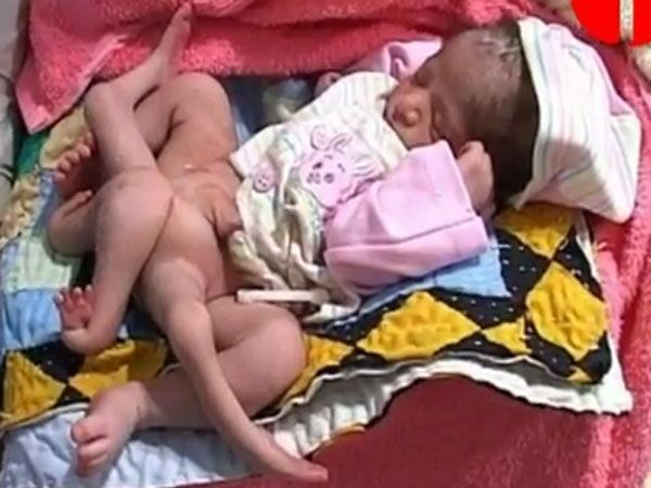 Gendefekt tritt nur in einem von einer Million Fällen auf Gendefekt tritt nur in einem von einer Million Fällen auf