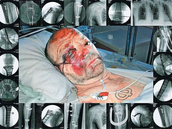 "Ikarus in the house of pain" heißt diese Arbeit, die auch die vielen Brüche zeigt, die Flatz von einem Autofahrer angetan wurden. "Ikarus in the house of pain" heißt diese Arbeit, die auch die vielen Brüche zeigt, die Flatz von einem Autofahrer angetan wurden.