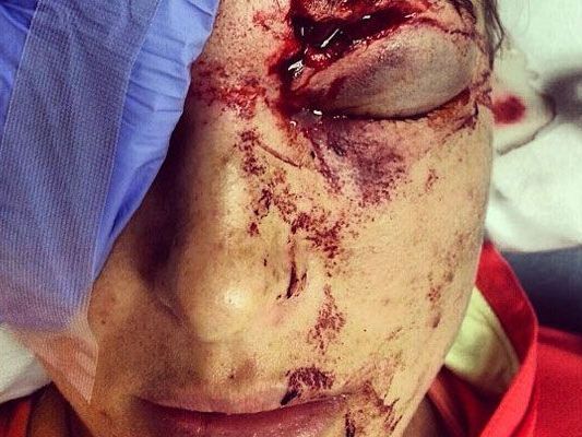 Der Golfball hat das Gesicht von Morgan Miller übel zugerichtet. Der Golfball hat das Gesicht von Morgan Miller übel zugerichtet.