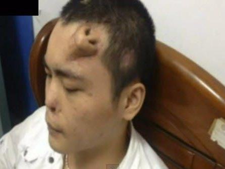 Auf der Stirn des Chinesen Xiaolian wurde eine neue Nase gezüchtet - die Transplantation an die richtige Stelle soll bald erfolgen.