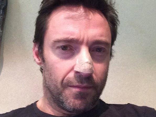 Hugh Jackman mit Pflaster auf Nase - wegen Hautkrebs behandelt Hugh Jackman mit Pflaster auf Nase - wegen Hautkrebs behandelt