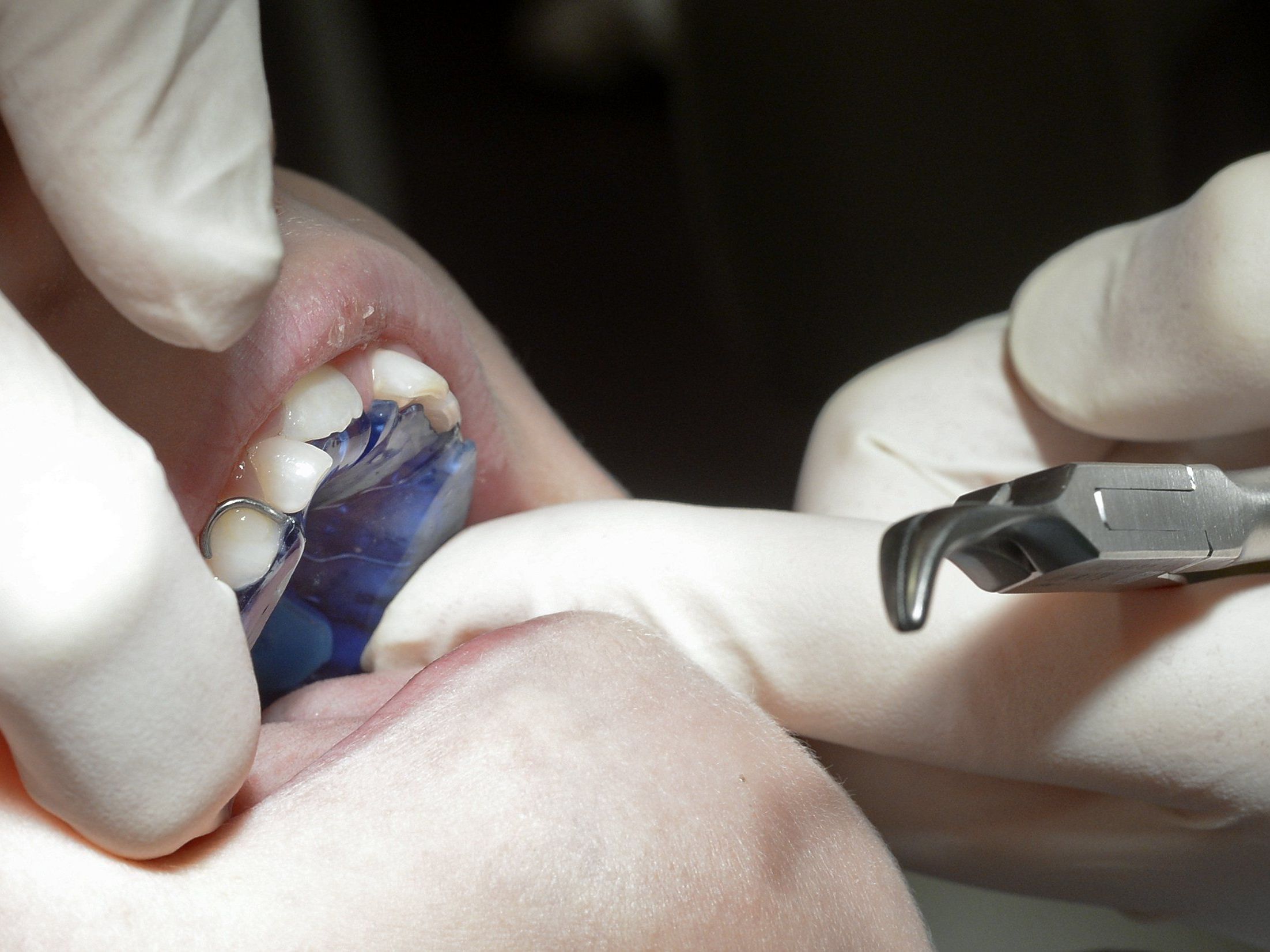 Pro Jahr sollen rund 30.000 unter 18-Jährige von der Gratiszahnspange profitieren. Pro Jahr sollen rund 30.000 unter 18-Jährige von der Gratiszahnspange profitieren.