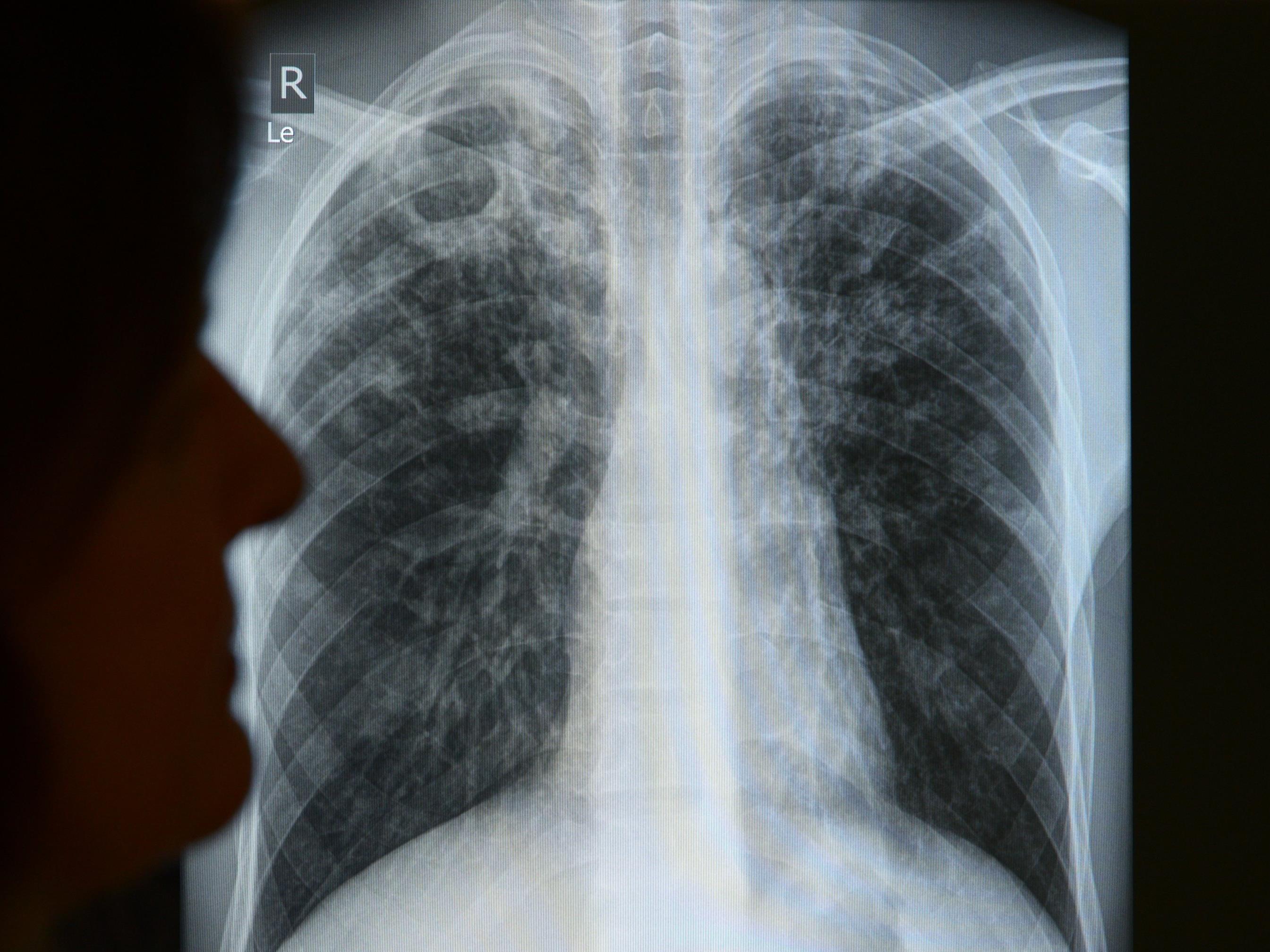 26 neue Tuberkulosefälle wurde 2015 in Vorarlberg diagnostiziert.