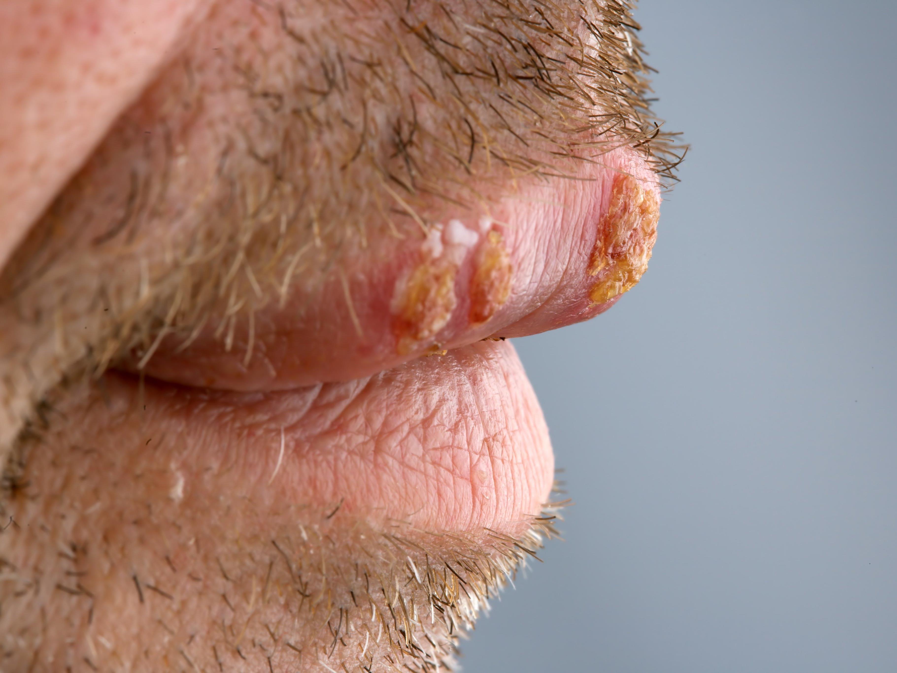 Bei einem Herpesausbruch kommt es zu schmerzhaften Bläschen. Am häufigsten sind die Lippen betroffen.