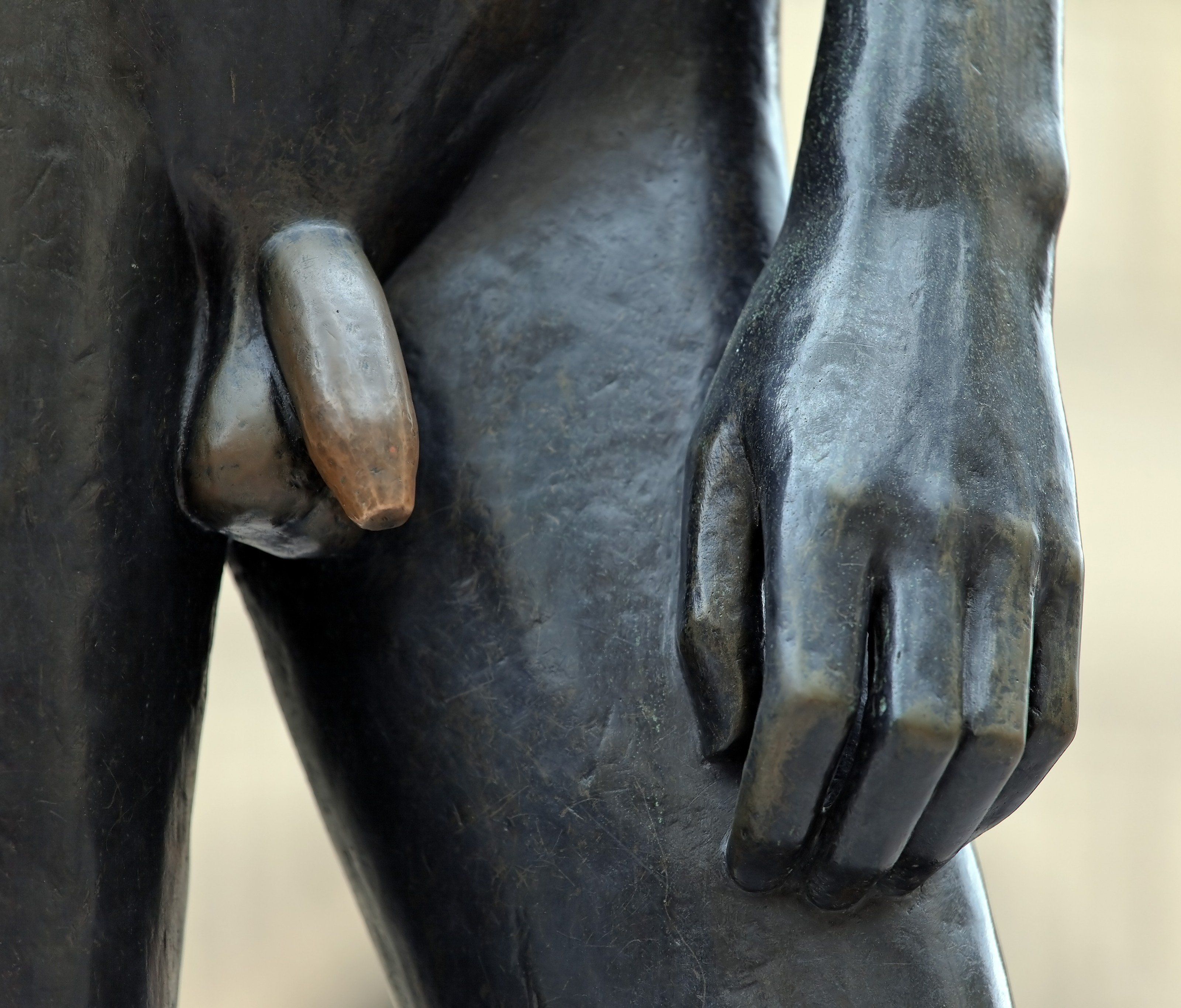 Penis erfolgreich transplantiert. Penis erfolgreich transplantiert.