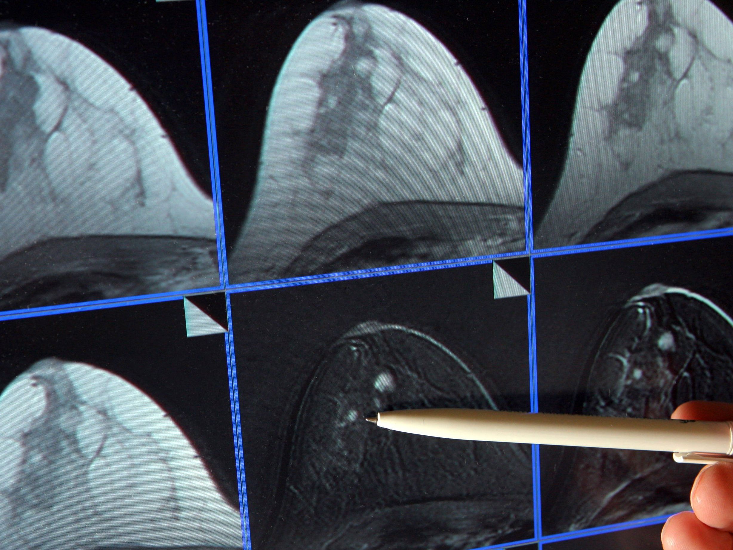 Das MR-Bild zeigt ein kleines Krebsgeschwür. Das MR-Bild zeigt ein kleines Krebsgeschwür.