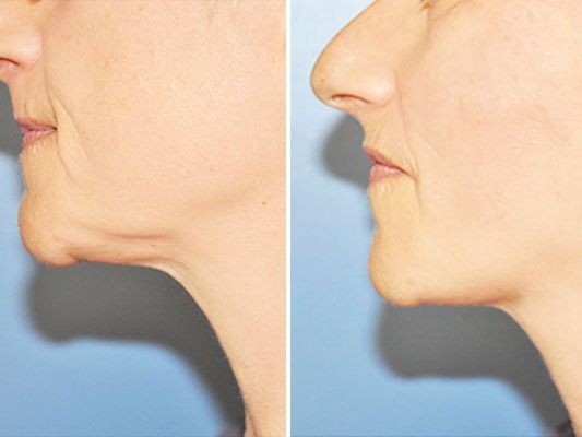 Bild links: Vor der Behandlung. Rechts: Danach. Bild links: Vor der Behandlung. Rechts: Danach.